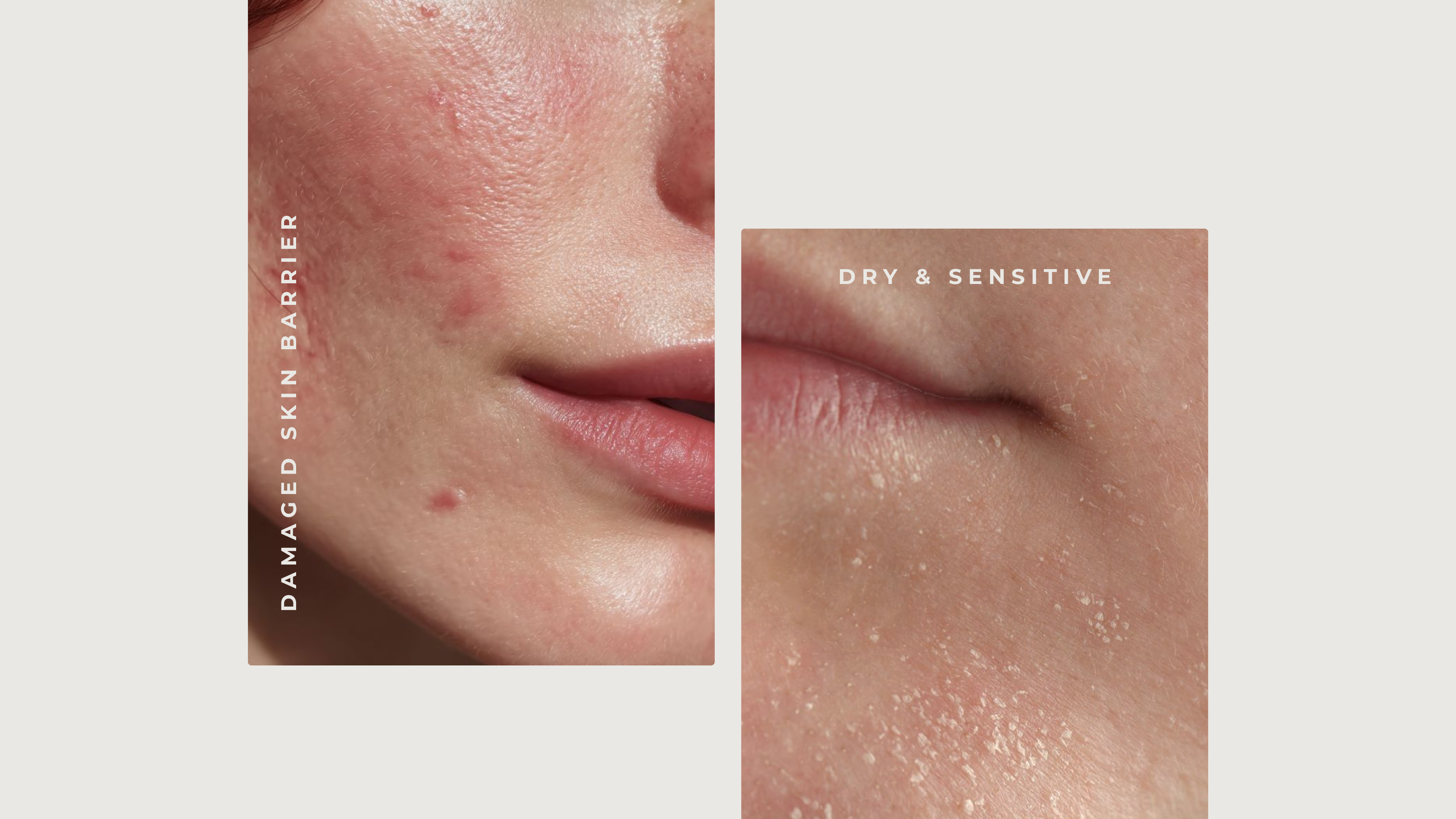 How Do I Recognize a Damaged Skin Barrier vs. Normal Dry or Sensitive Skin?